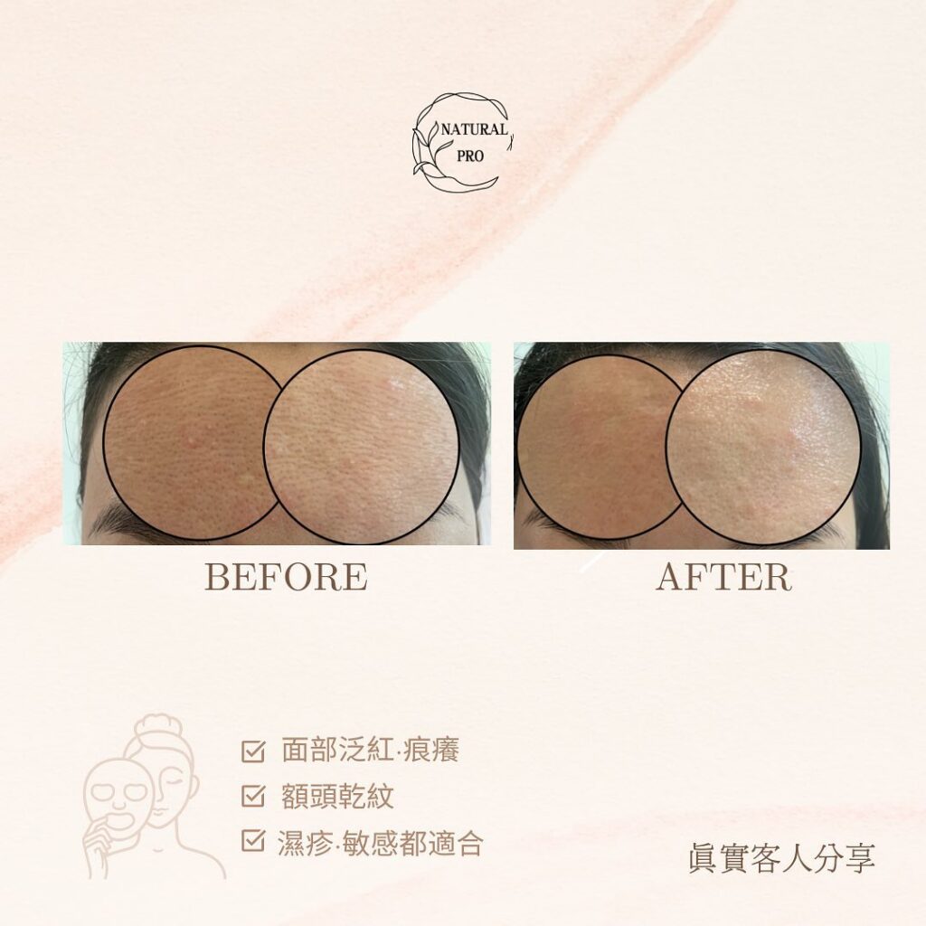 T字位出油問題，因為底層缺乏水份，平衡唔到所以出油. 咁要即時保水，令皮膚得到平衡，皮膚無咁油就唔會出暗粒同埋啲乾紋❤️ 🥇店主5星推介🔥冰川水感肌（適合沙漠敏感肌、抗敏同時注入大量精華）💦仲有放題式精華,你吸幾多我比幾多✅ 我哋所有療程都包針清收眉㗎😌 仲係💯單次收費
