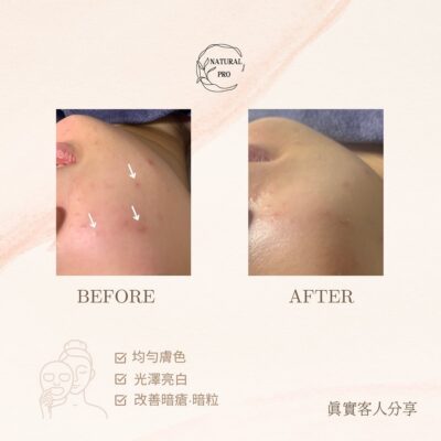 客人主要想改善暗瘡,暗粒,敏感問題